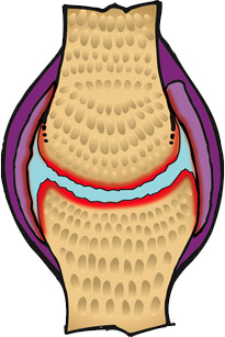 Osteoarthritic Joint